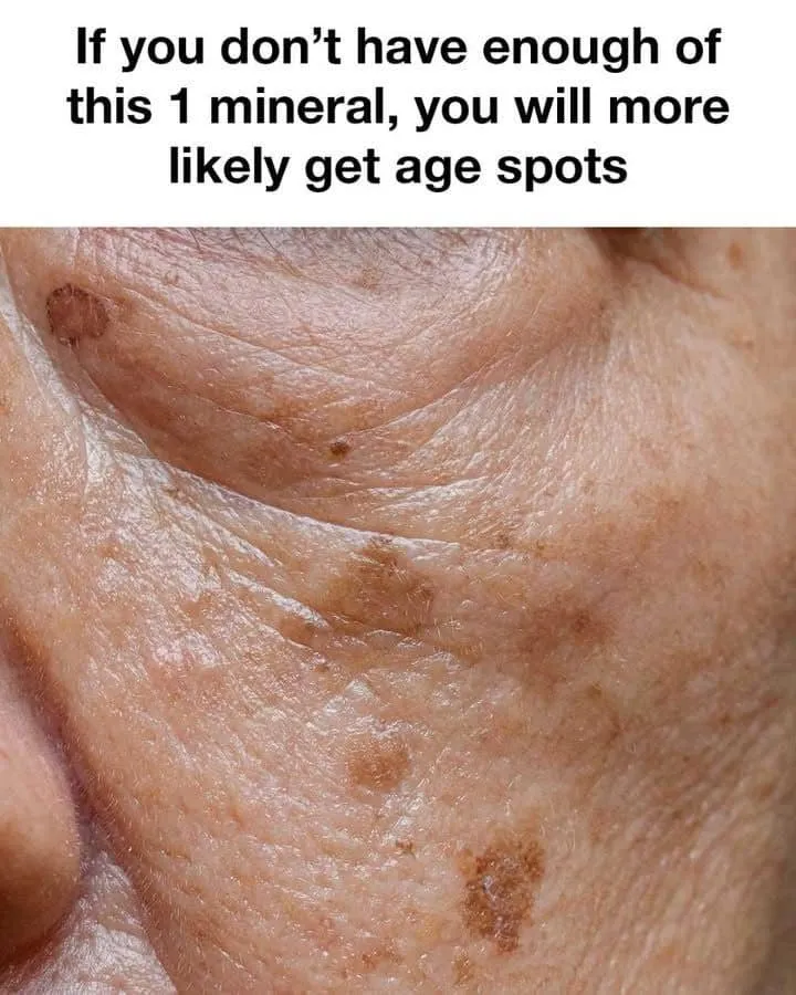 If you don't have enough of this 1 mineral, you will more likely get age spots