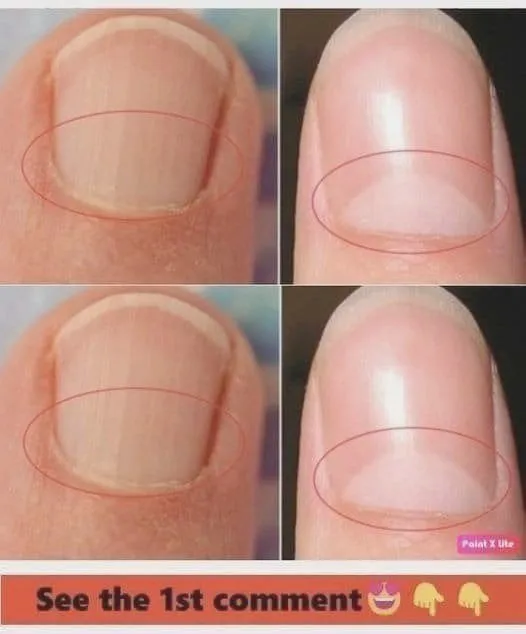 If you don't have a crescent moon shape on your nails, take care immediately