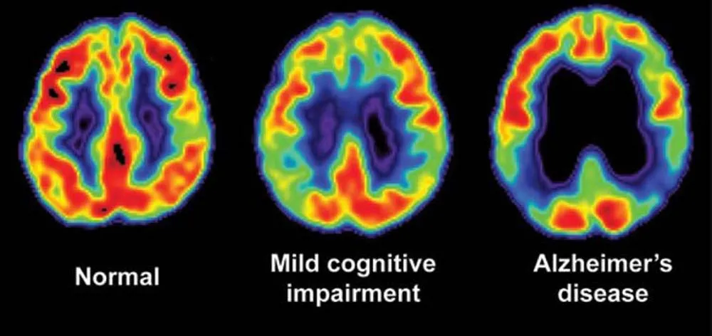 Can Sound Heal the Brain? How 40Hz Audio Stimulation Is Offering New Hope Against Alzheimer’s